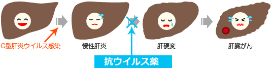 インターフェロン治療